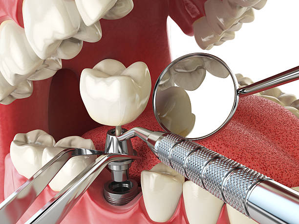 Best Emergency Treatment for Dental Infections or Abscesses in Westbury, NY